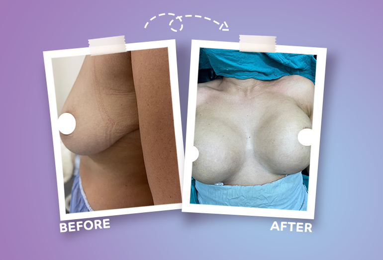 تكبير الثدي